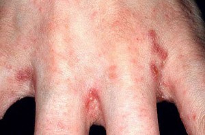 scabies_hand07